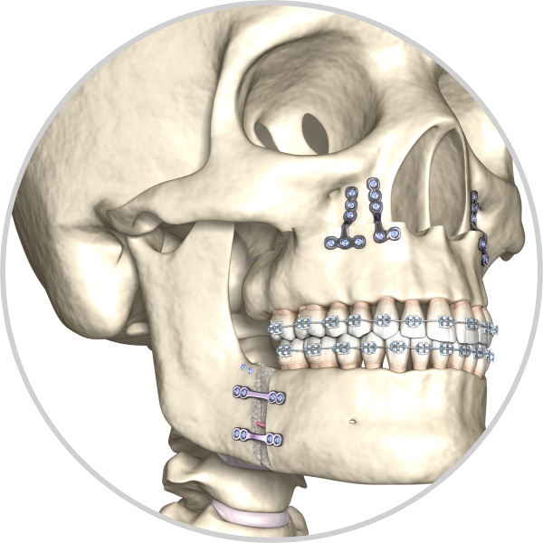 Craniomaxillofacial